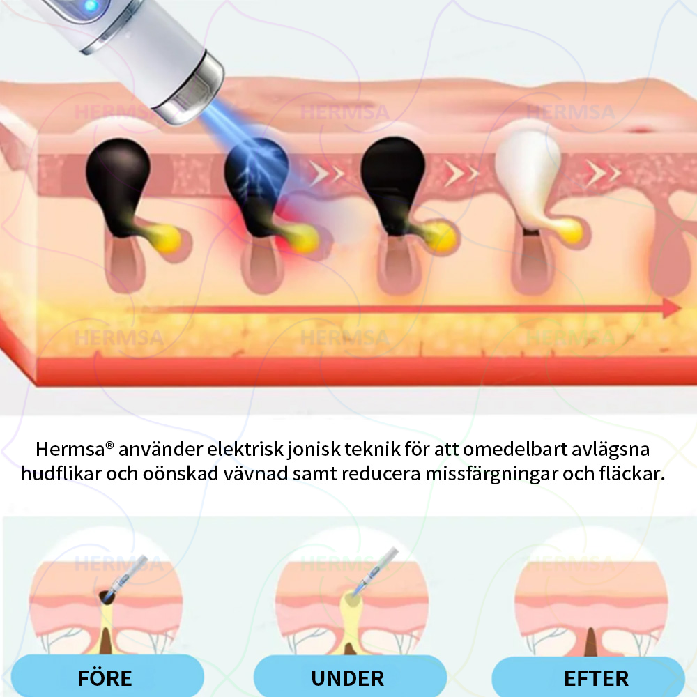 Hermsa® icke-invasiv laserskalare - avlägsnande av ben och vårtor (🔥Sista dagen 80% rabatt)