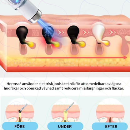 Hermsa® icke-invasiv laserskalare - avlägsnande av ben och vårtor (🔥Sista dagen 80% rabatt)