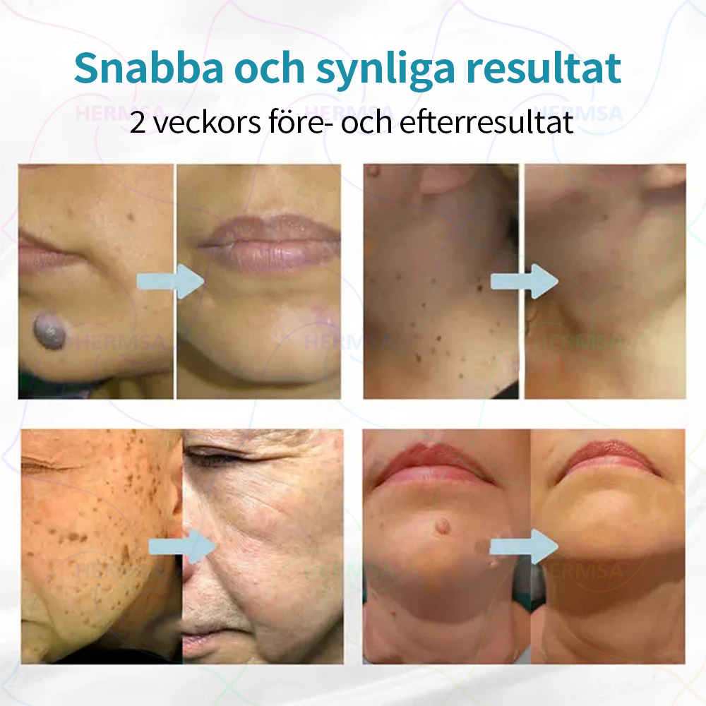 Hermsa® icke-invasiv laserskalare - avlägsnande av ben och vårtor (🔥Sista dagen 80% rabatt)