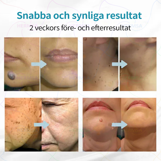 Hermsa® icke-invasiv laserskalare - avlägsnande av ben och vårtor (🔥Sista dagen 80% rabatt)
