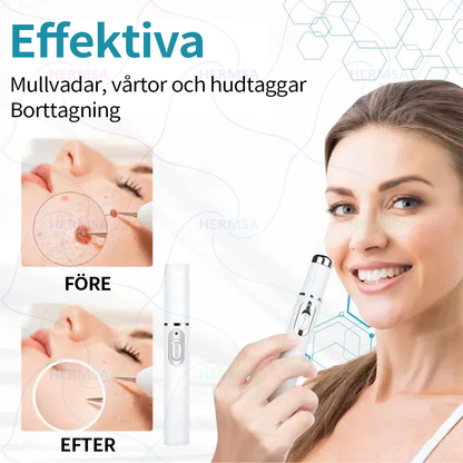 Hermsa® icke-invasiv laserskalare - avlägsnande av ben och vårtor (🔥Sista dagen 80% rabatt)